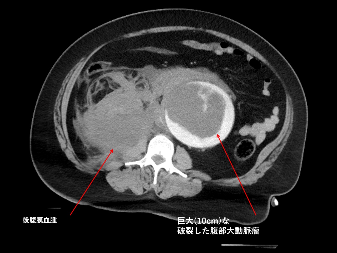 腹部 大動脈 瘤 破裂